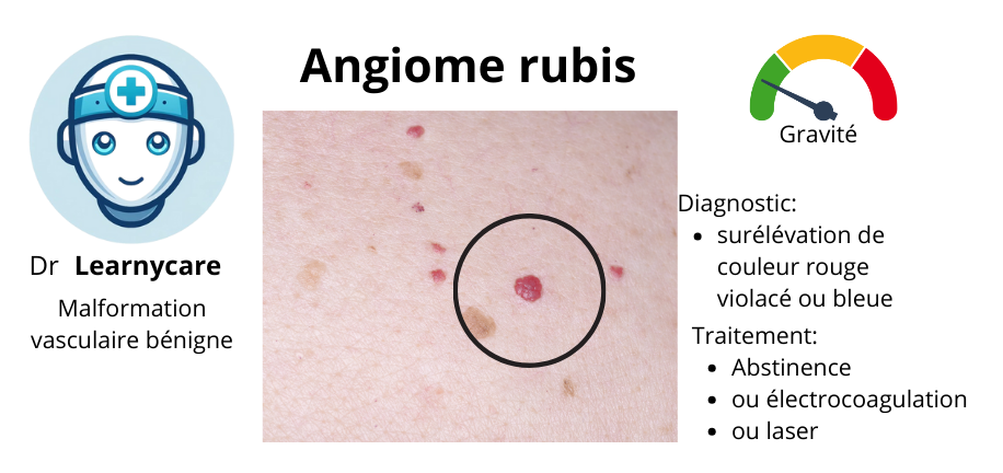 Angiome rubis infographie Dr Learnycare