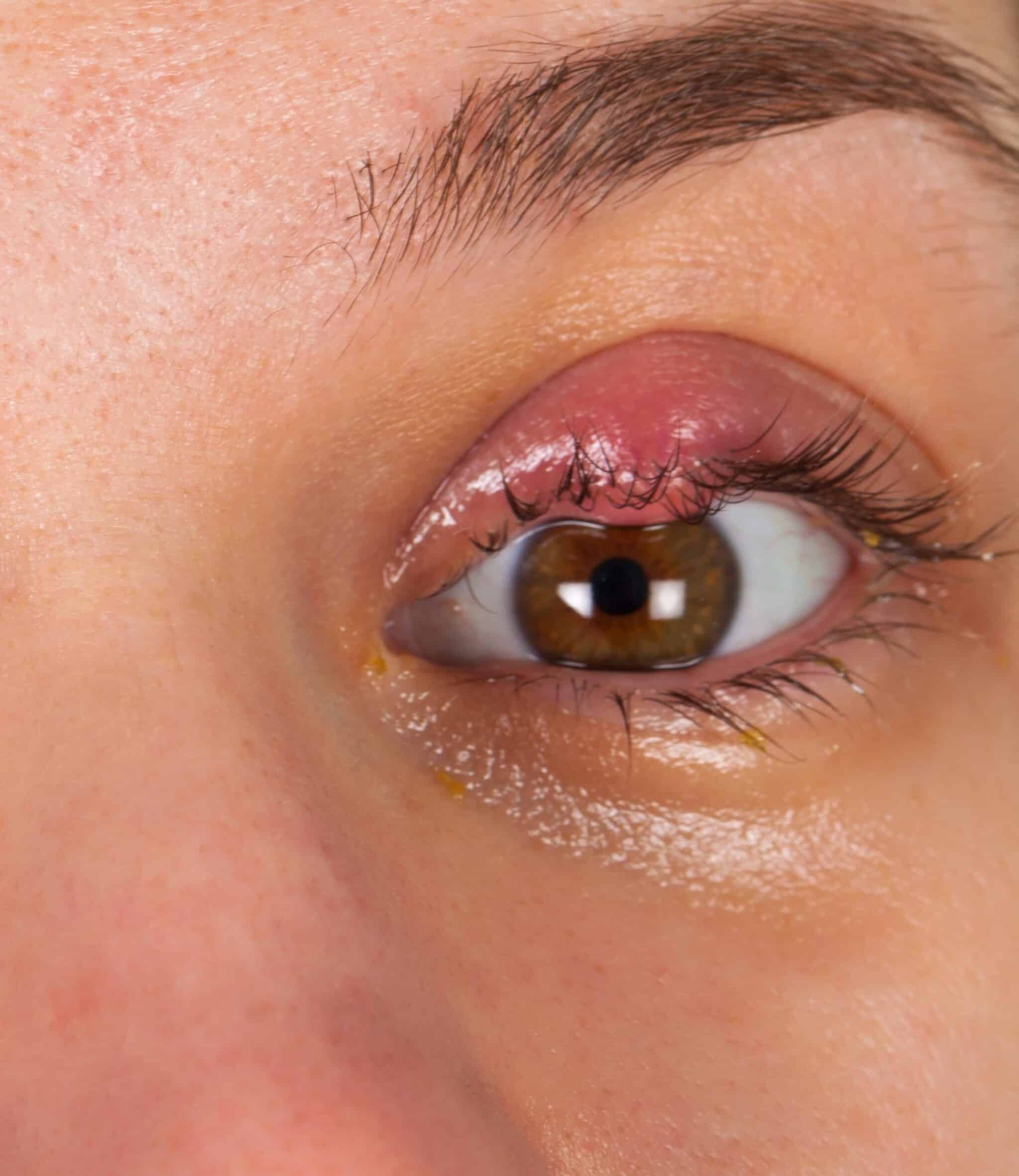 Chalazion