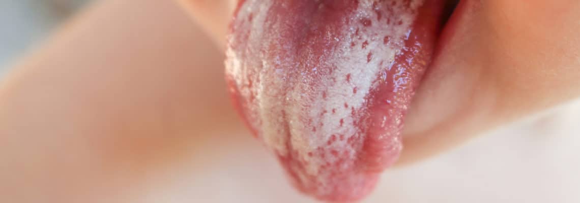 Mycose de bouche