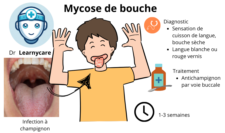 Mycose buccale infographie Dr Learnycare