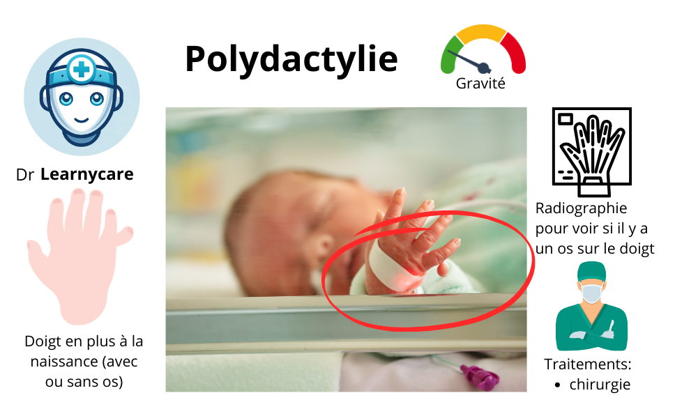 Polydactylie (doigt en plus) infographie Dr Learnycare