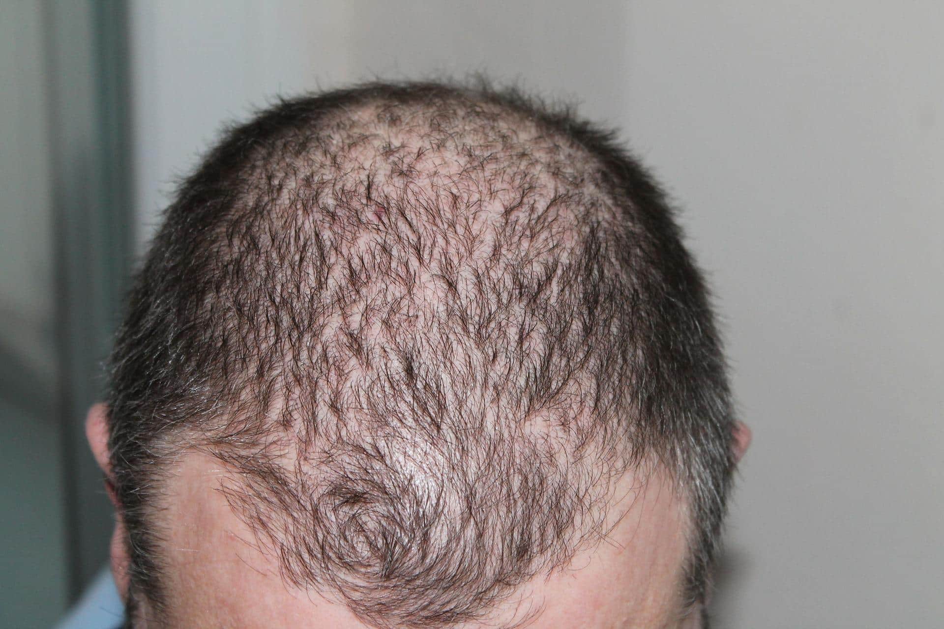 Perte de cheveux (calvitie) chez les hommes