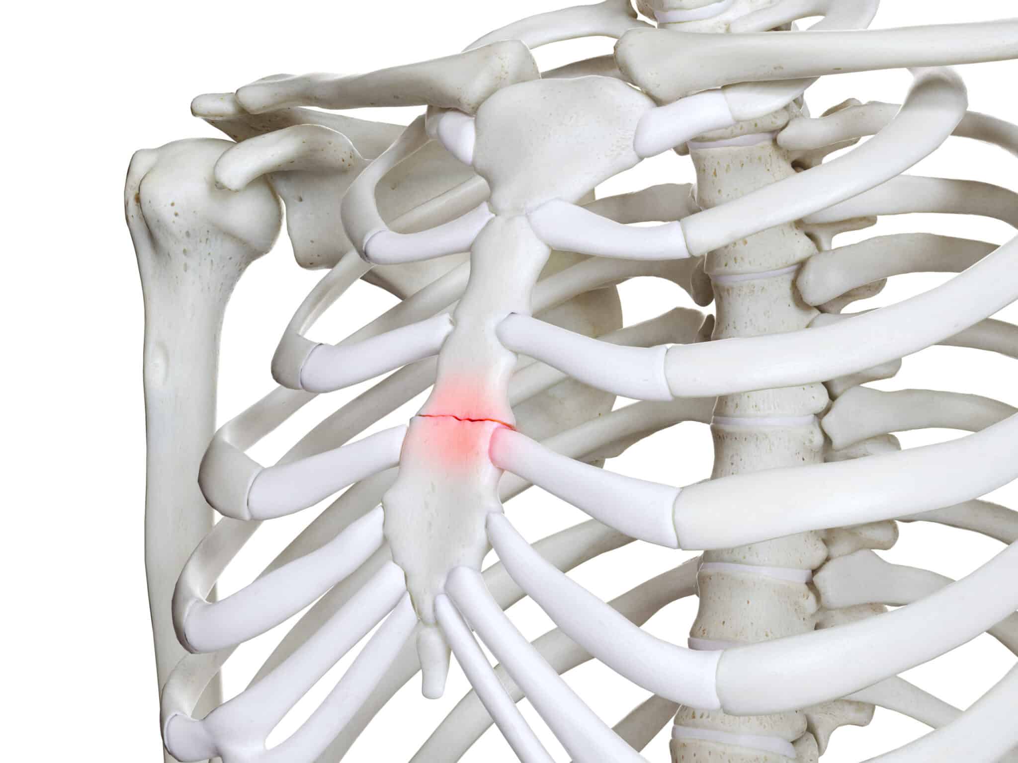 Fracture du sternum