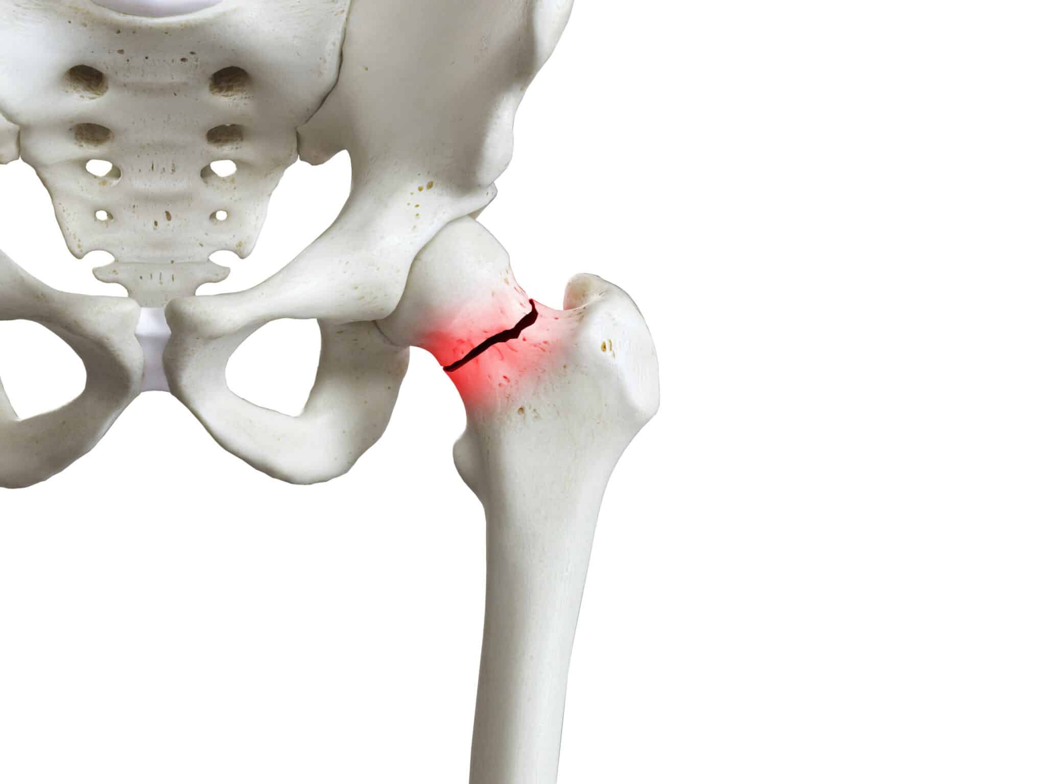 Fracture de la partie supérieure du fémur