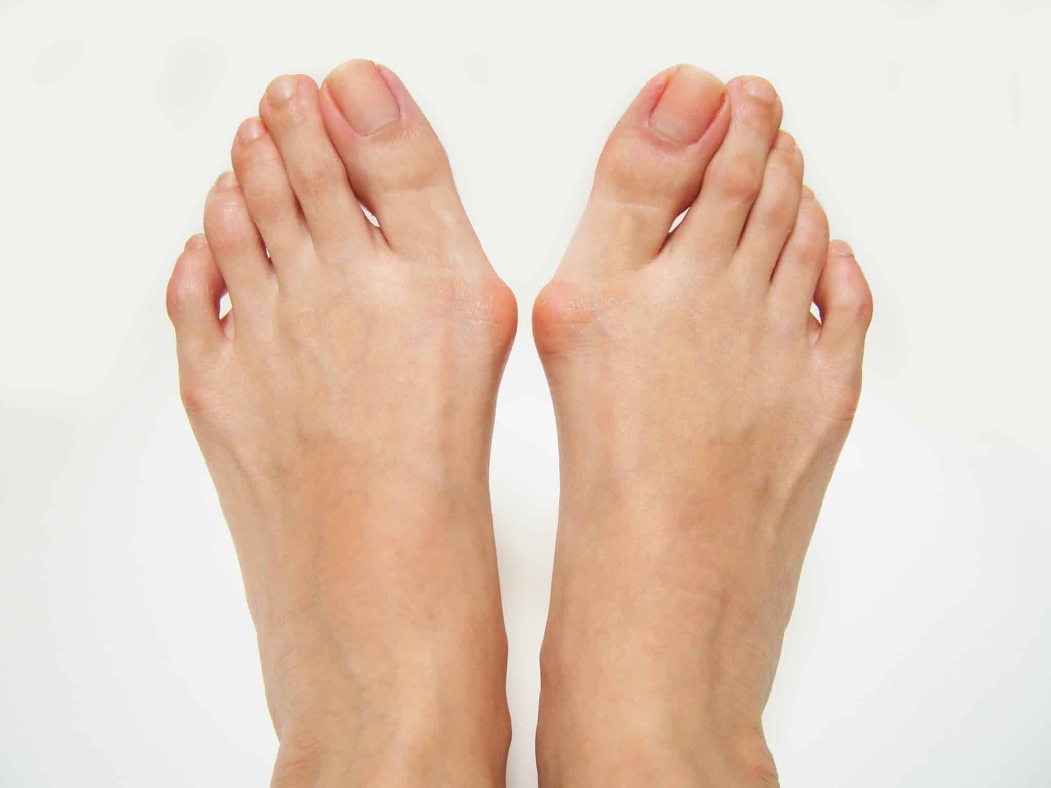 Hallux valgus