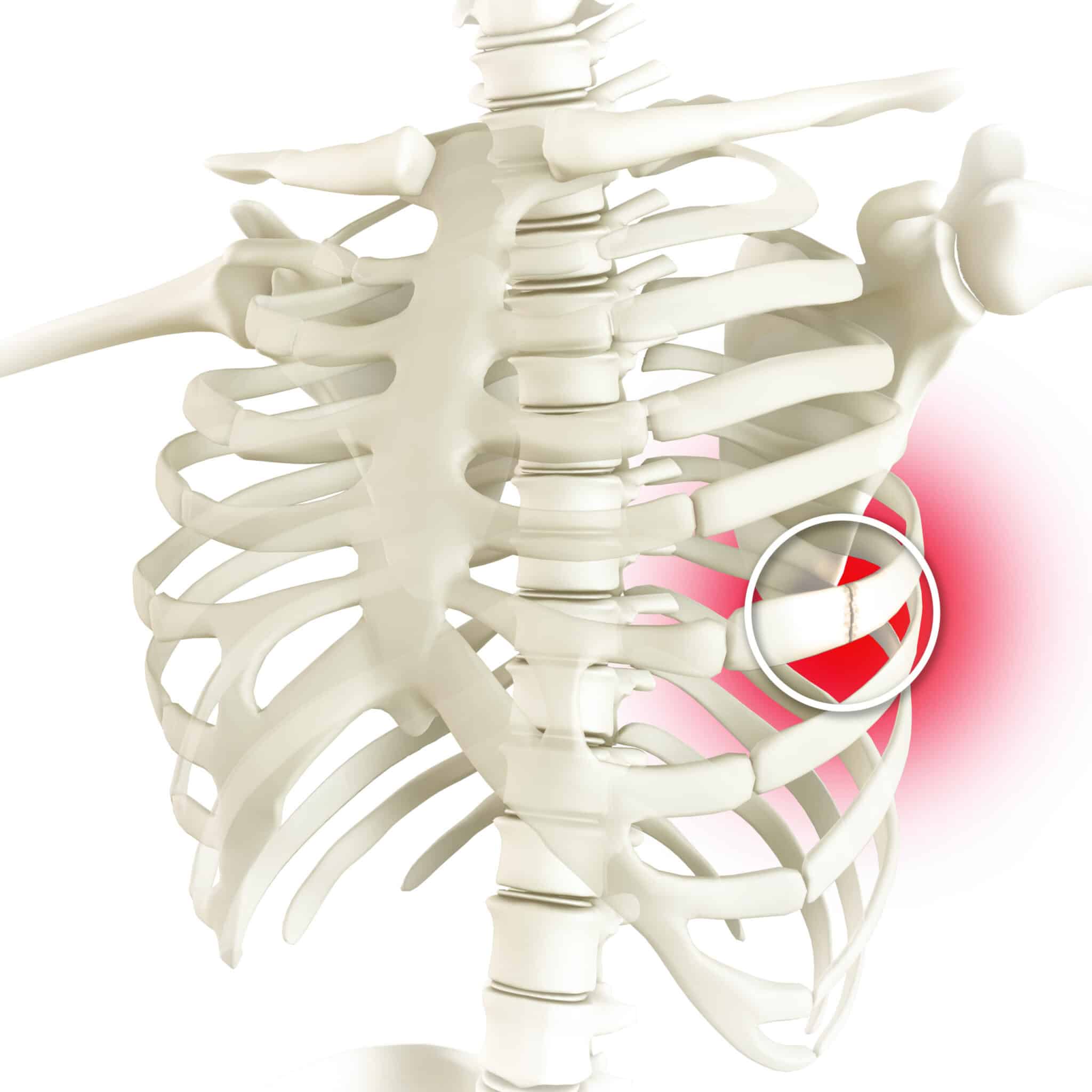 Fracture de côte