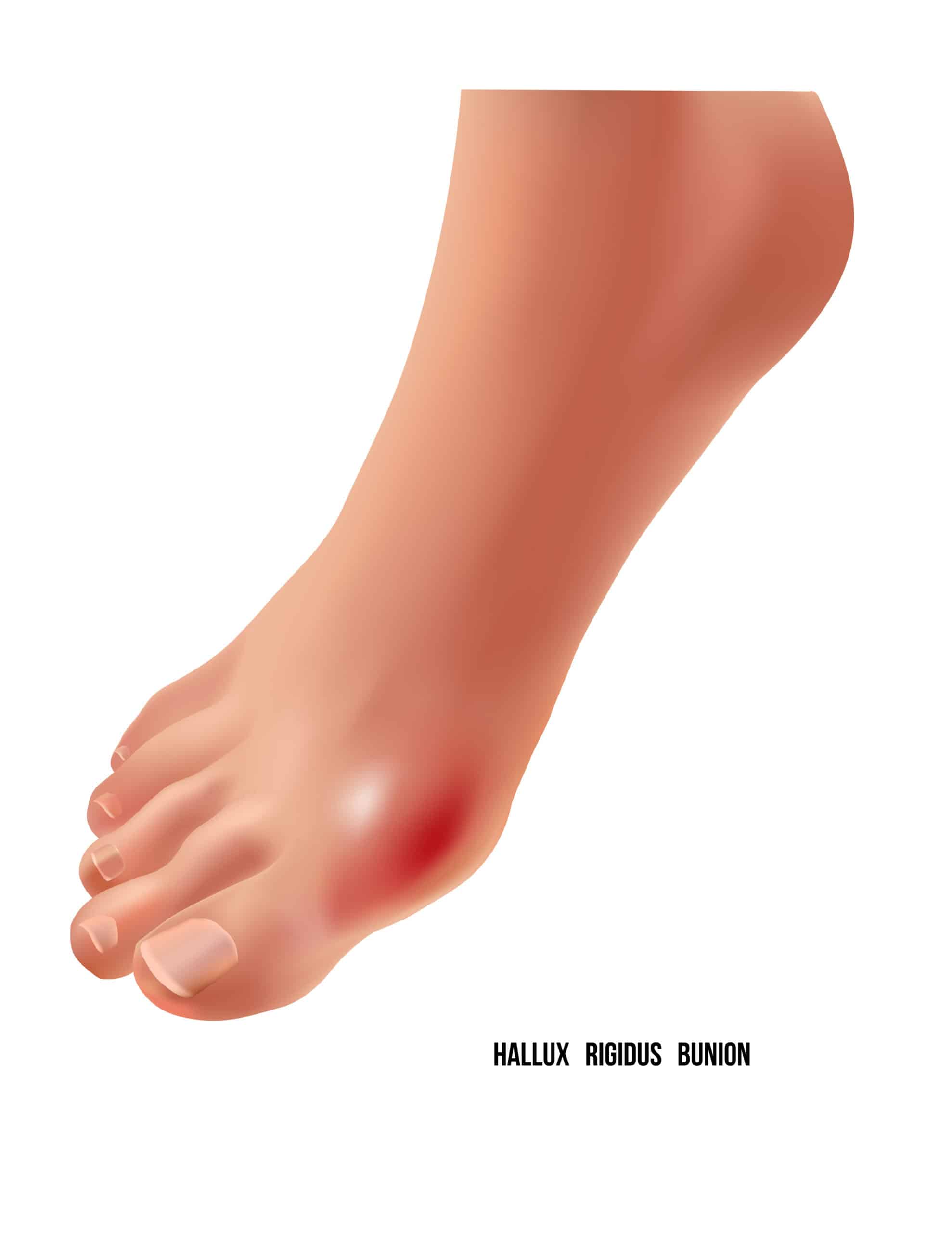 Hallux rigidus