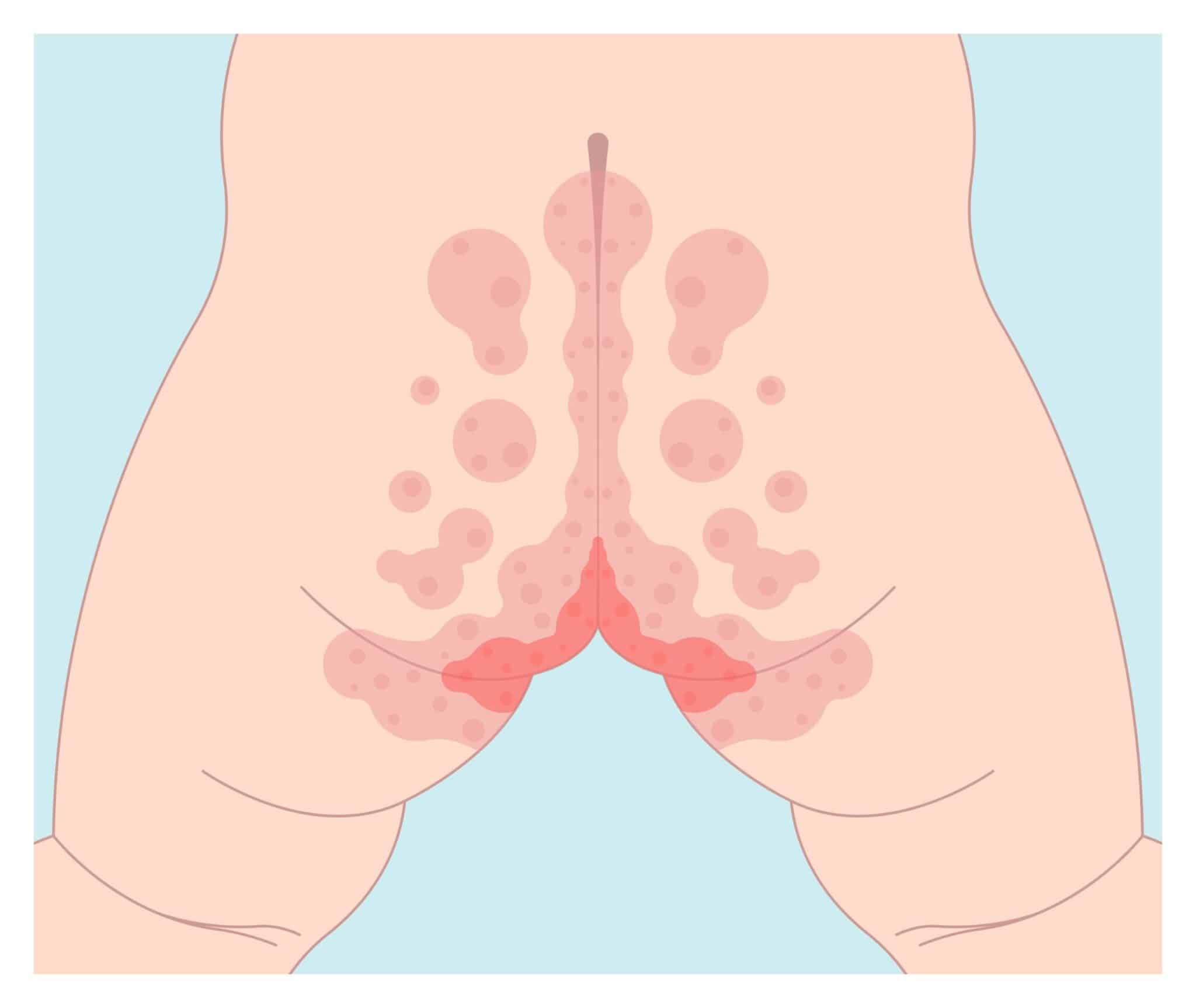 Epidermolyse staphylococcique