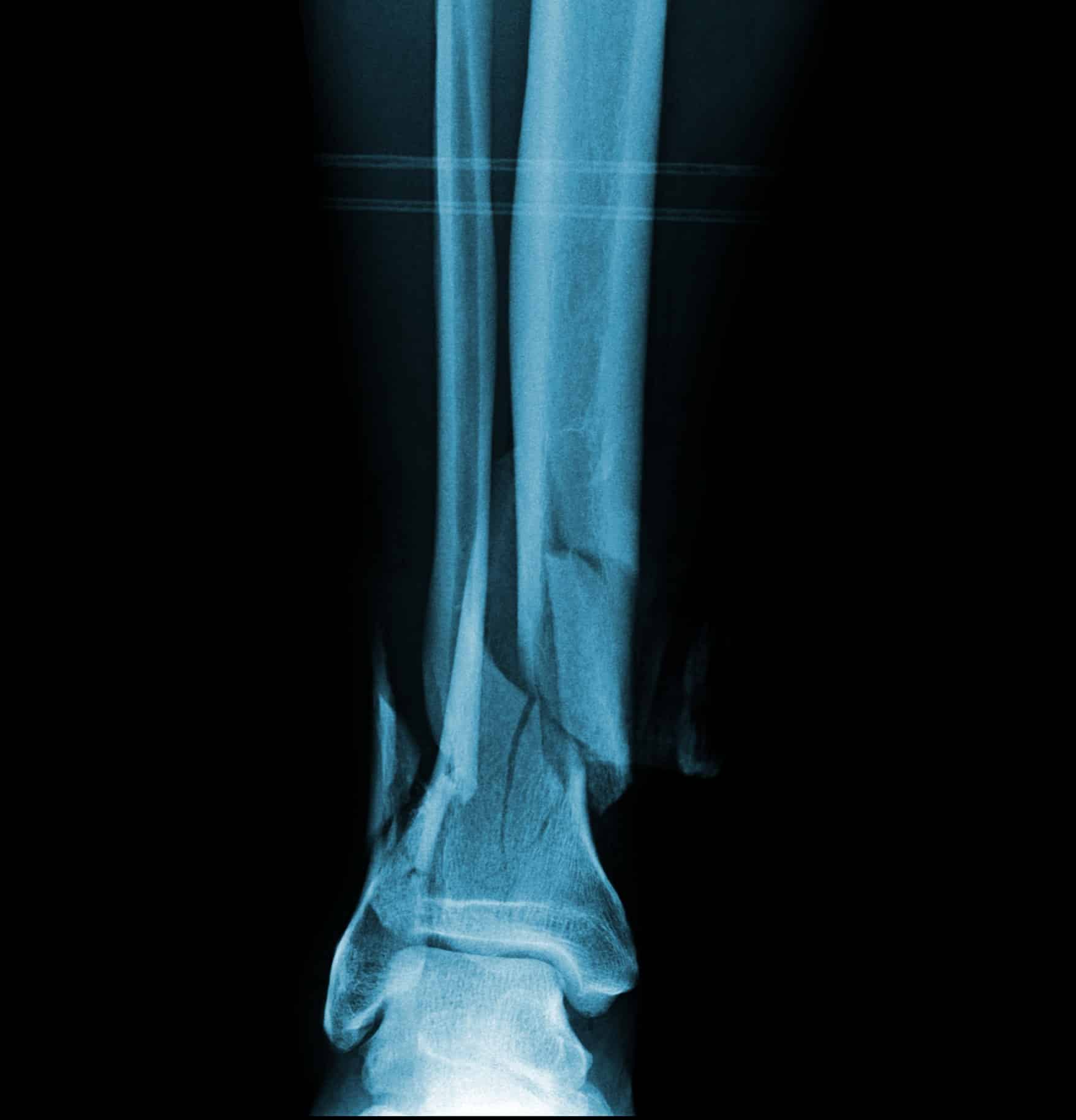 Mauvaise consolidation de fracture