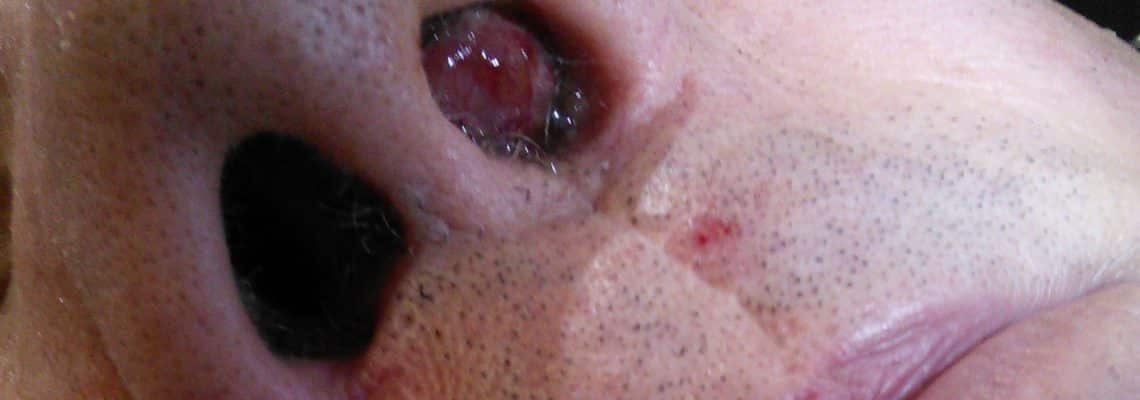 Fibrome nasopharyngien