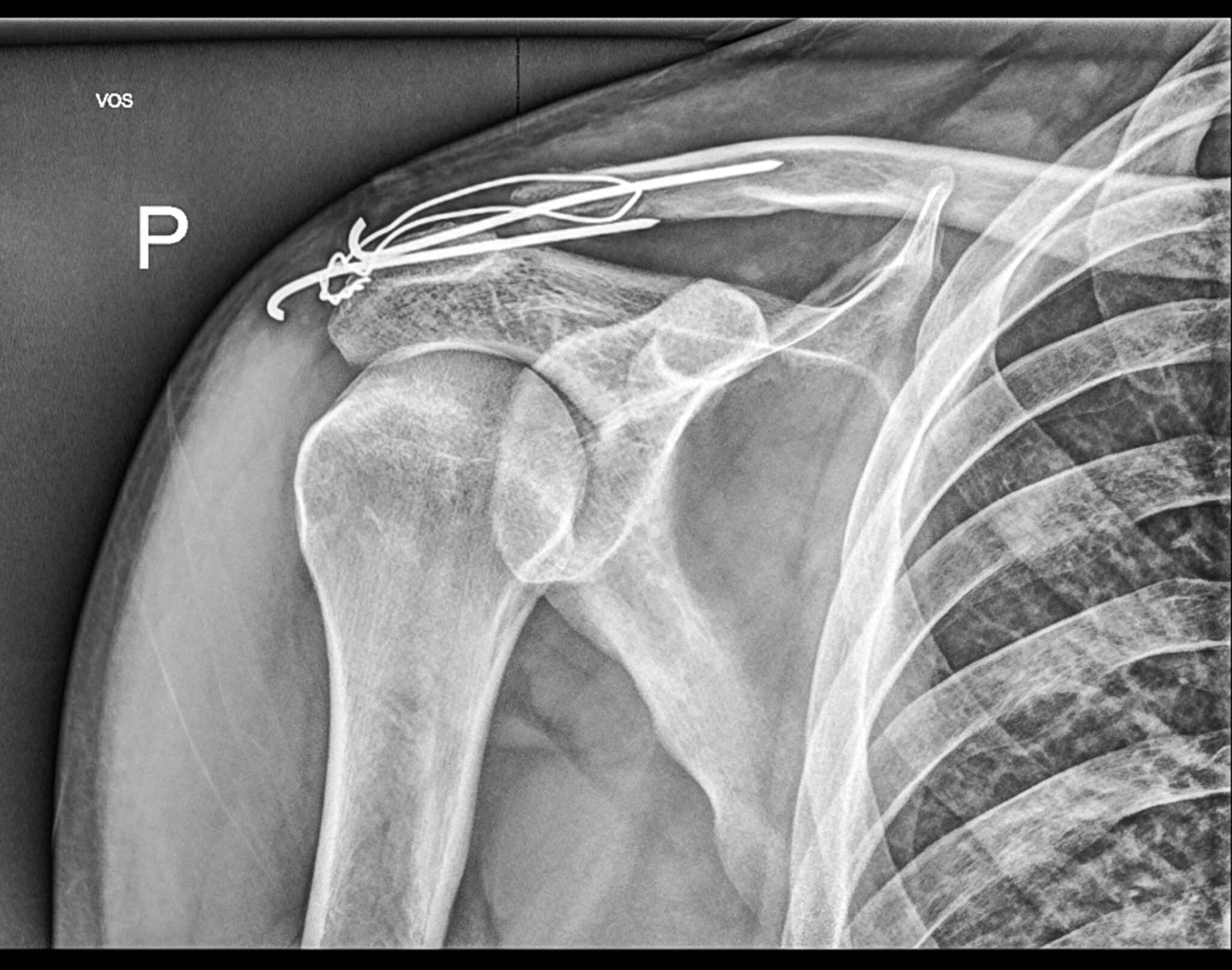 Fracture de clavicule