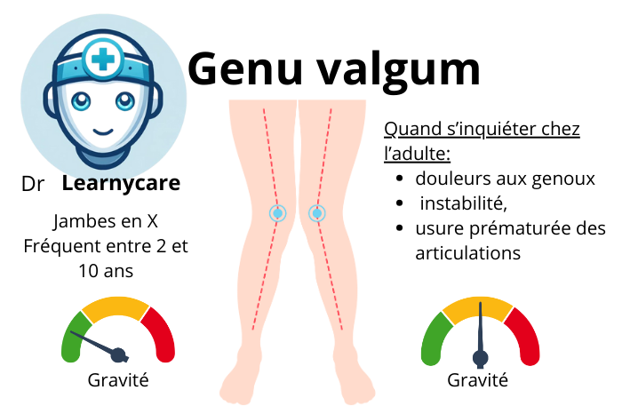 Genu valgum infographie Dr Learnycare