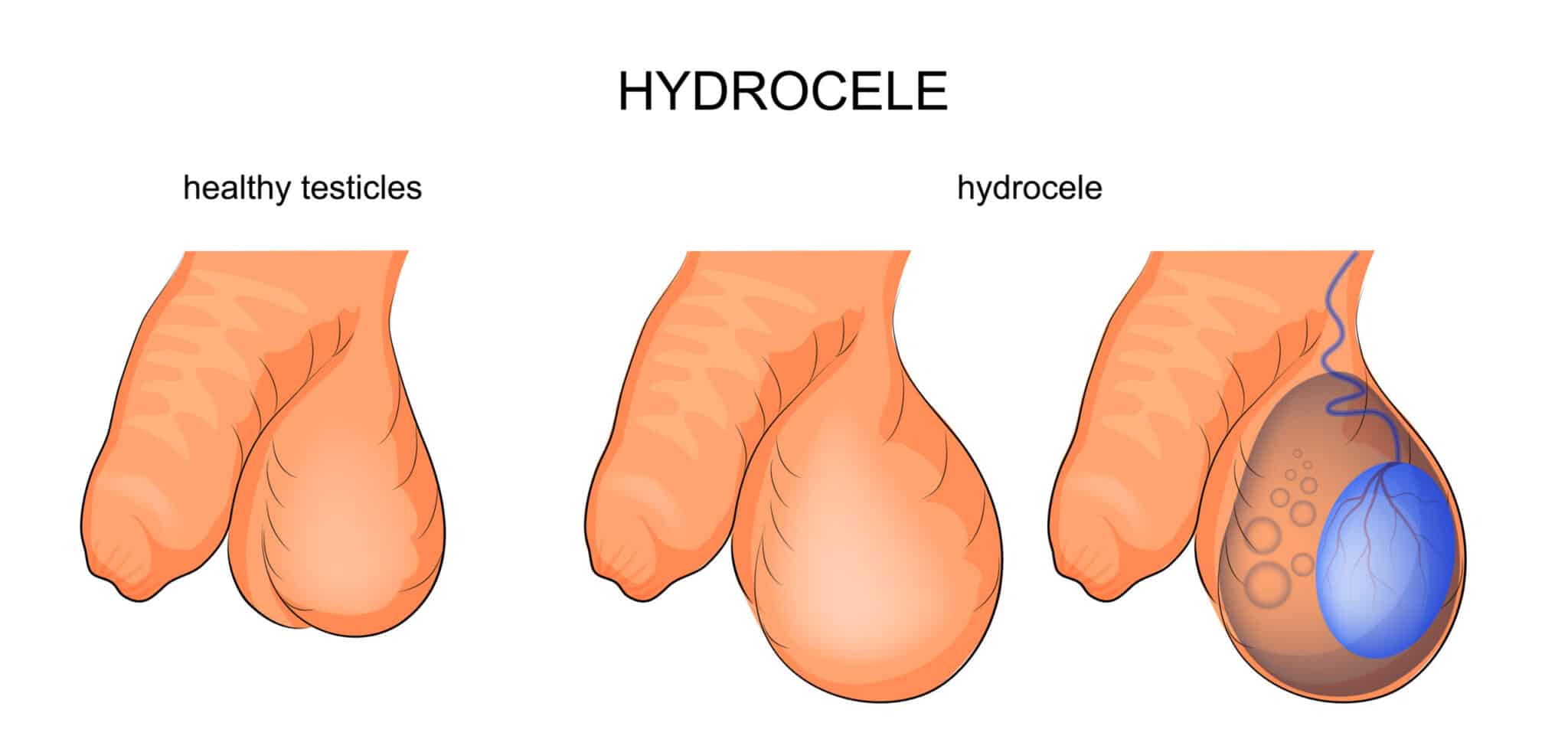 Hydrocèle