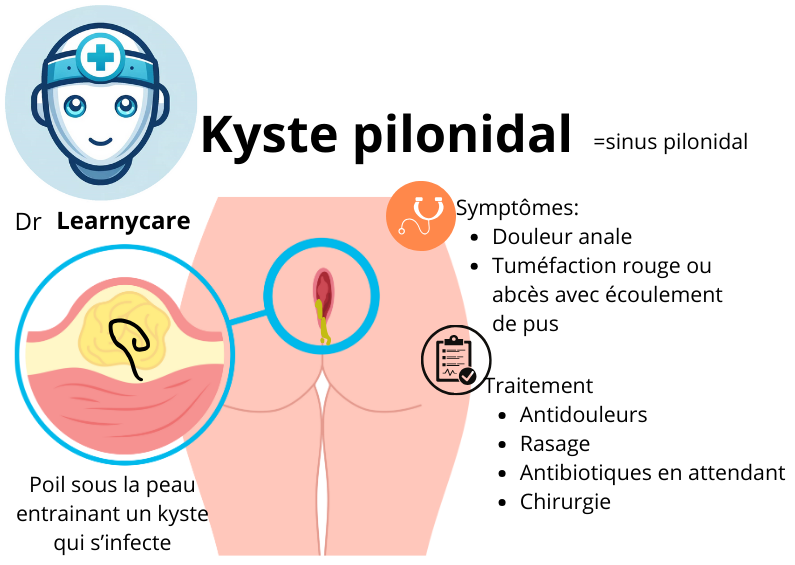 Kyste pilonidal infographie Dr Learnycare