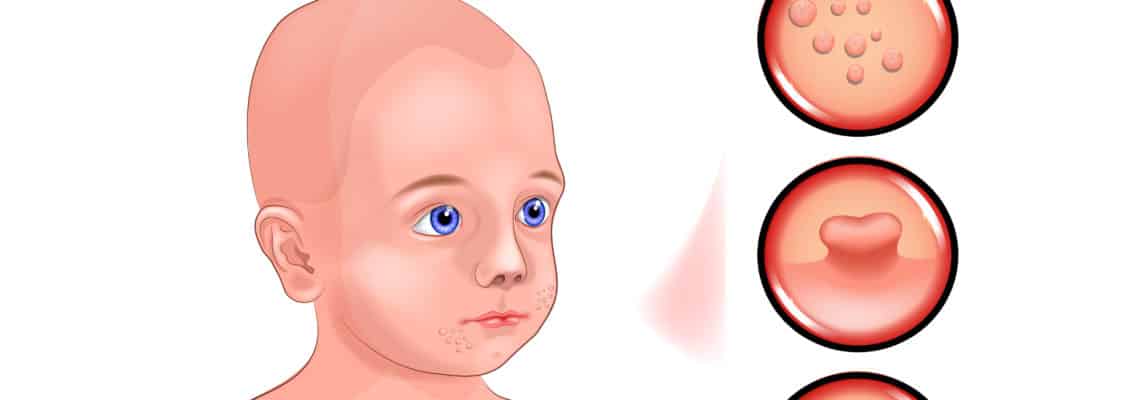 Molluscum contagiosum