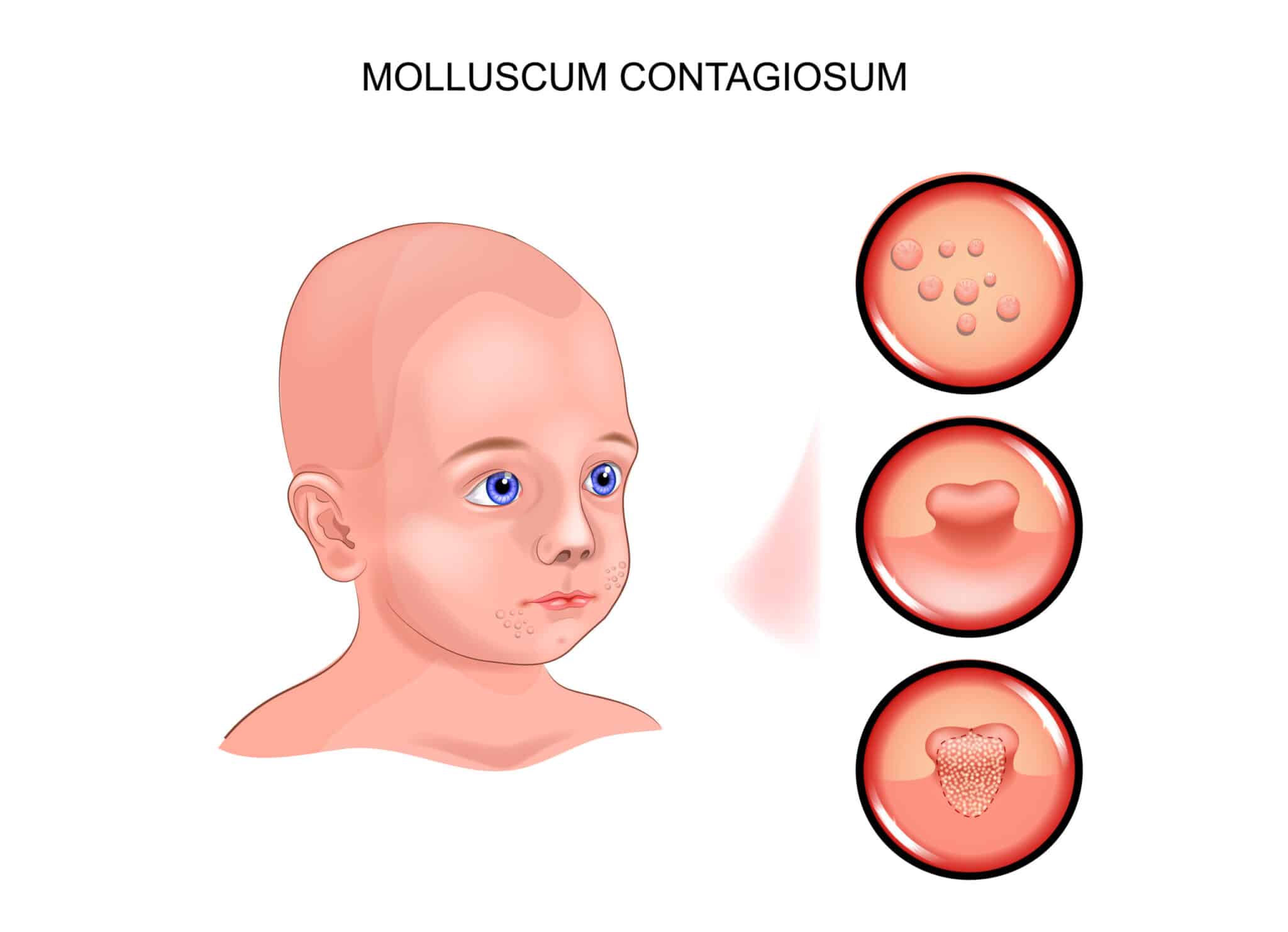 Molluscum contagiosum