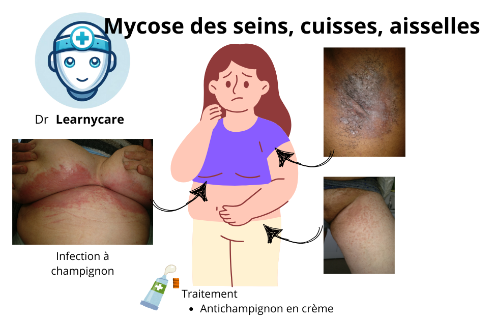 Mycose des seins, cuisses, aisselles infographie Dr Learnycare