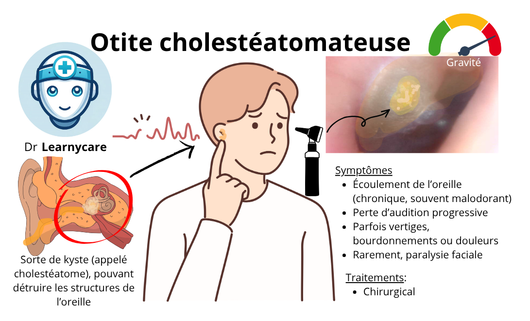 Otite cholestéatomateuse infographie Dr Learnycare