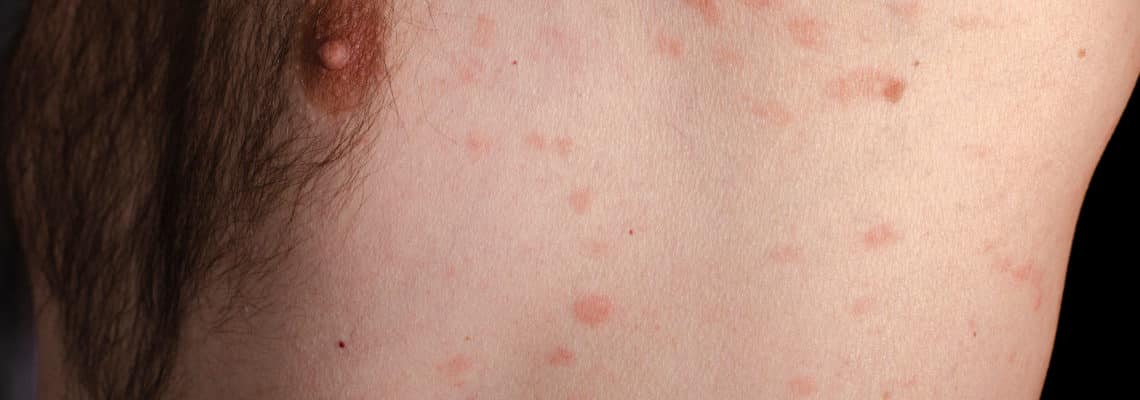 Pityriasis rosé de Gibert