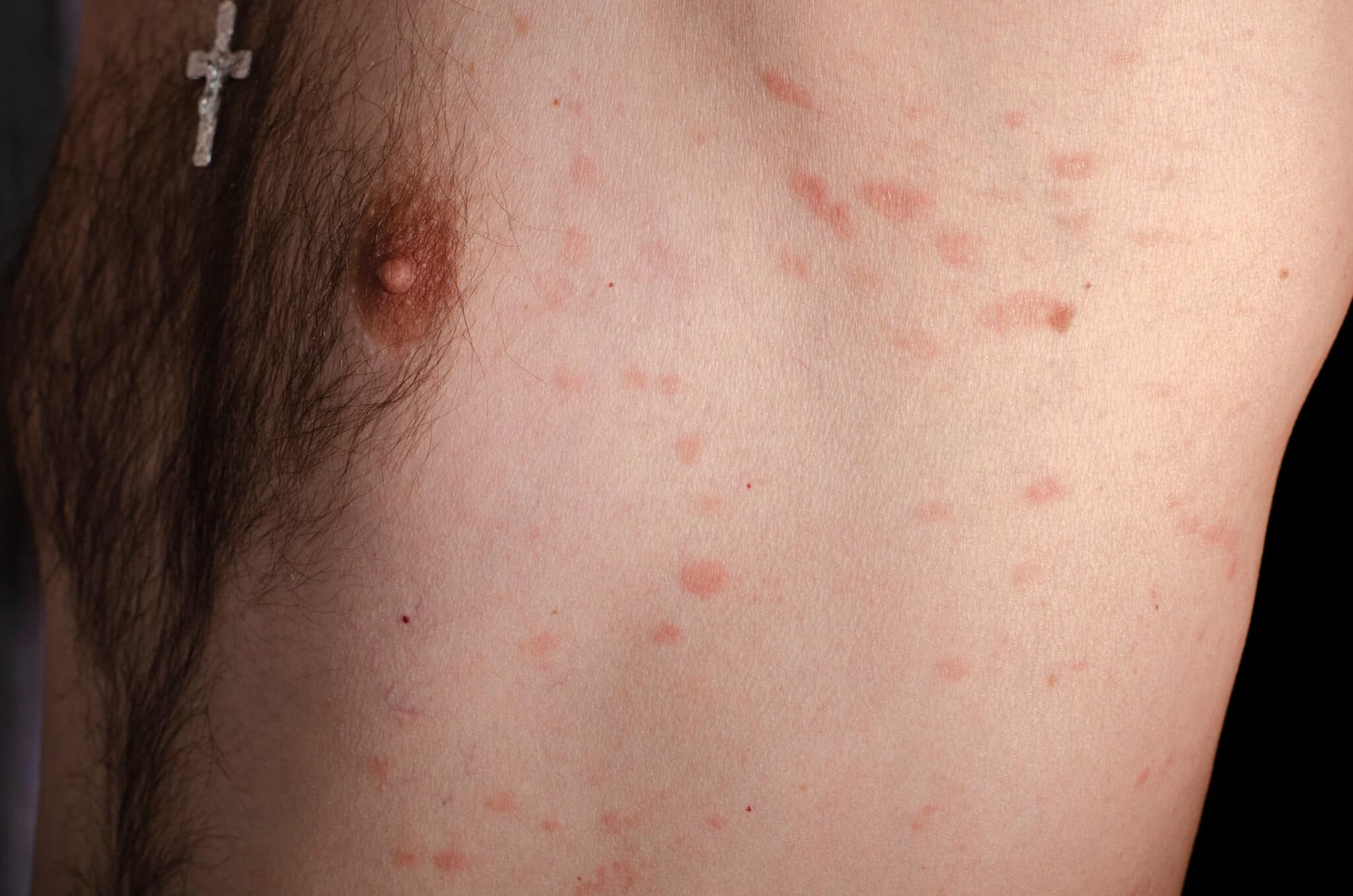 Pityriasis rosé de Gibert