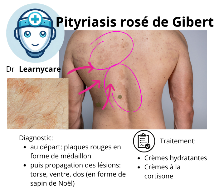 Pityriasis rosé de Gibert infographie Dr Learnycare