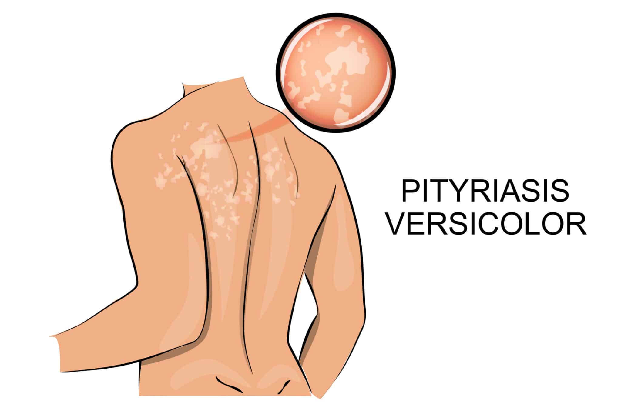 Pityriasis versicolor