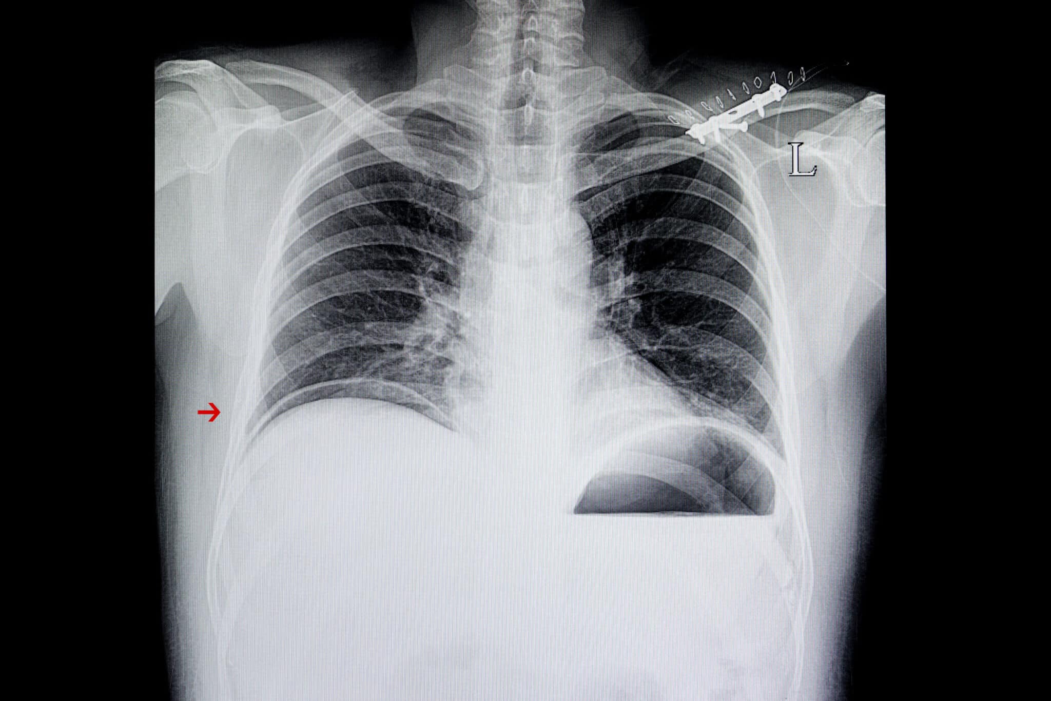 Rupture du diaphragme