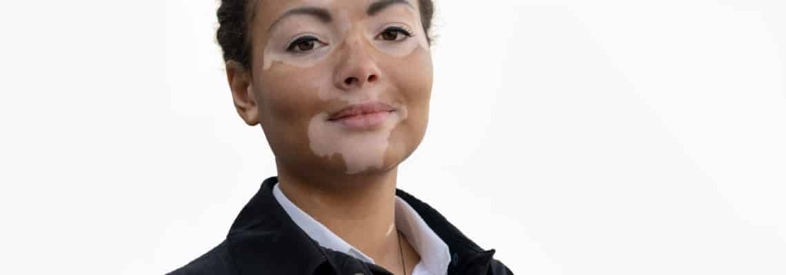 Vitiligo