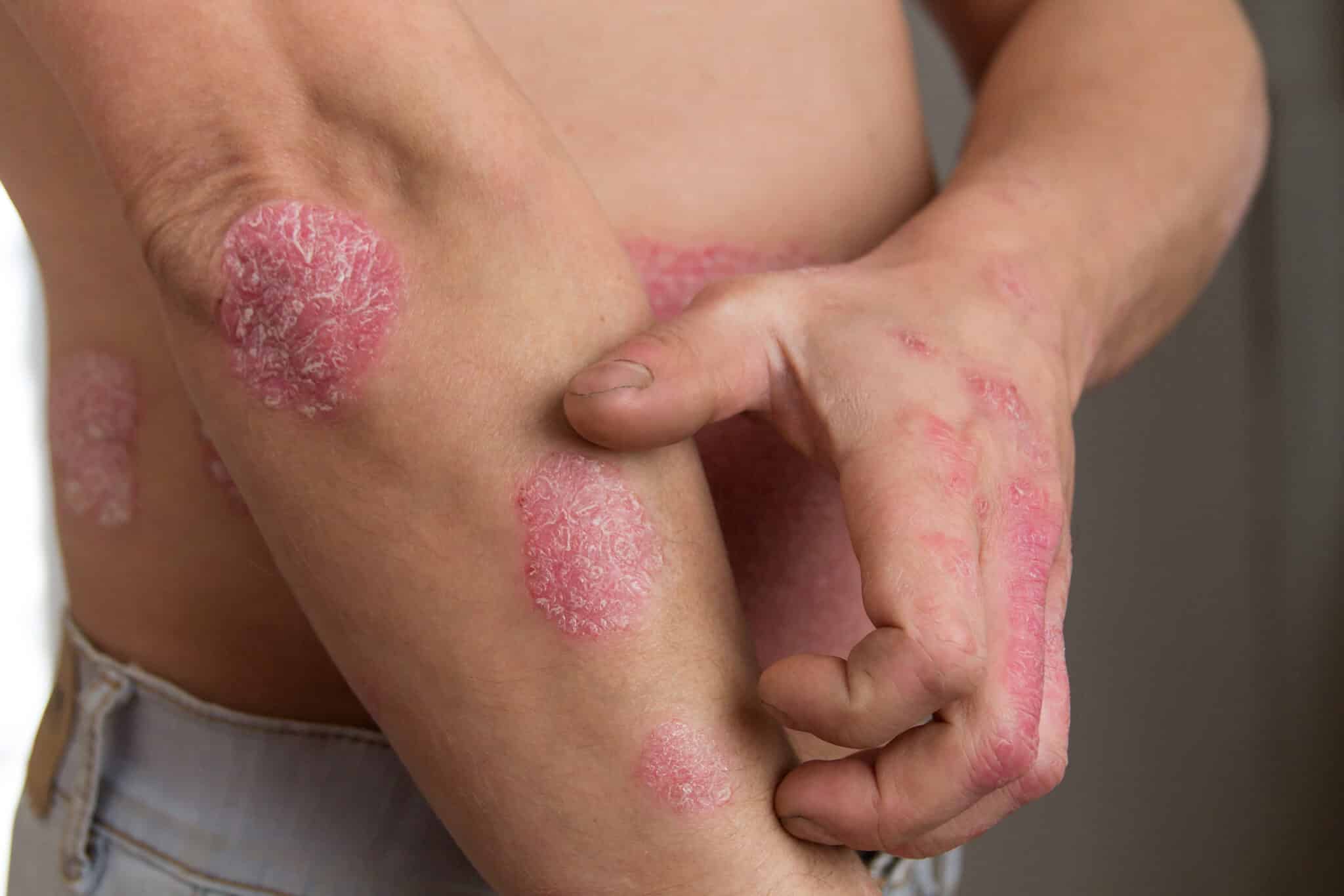 Psoriasis