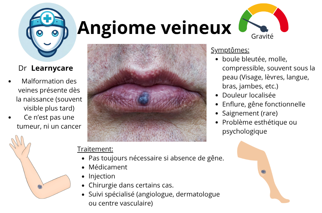 Angiome veineux infographie Dr Learnycare