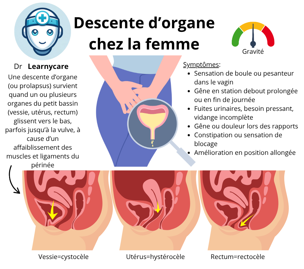 Descente d'organe (prolapsus) infographie Dr Learnycare