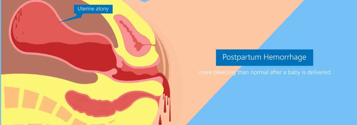 Rétention placentaire et hémorragie de la délivrance