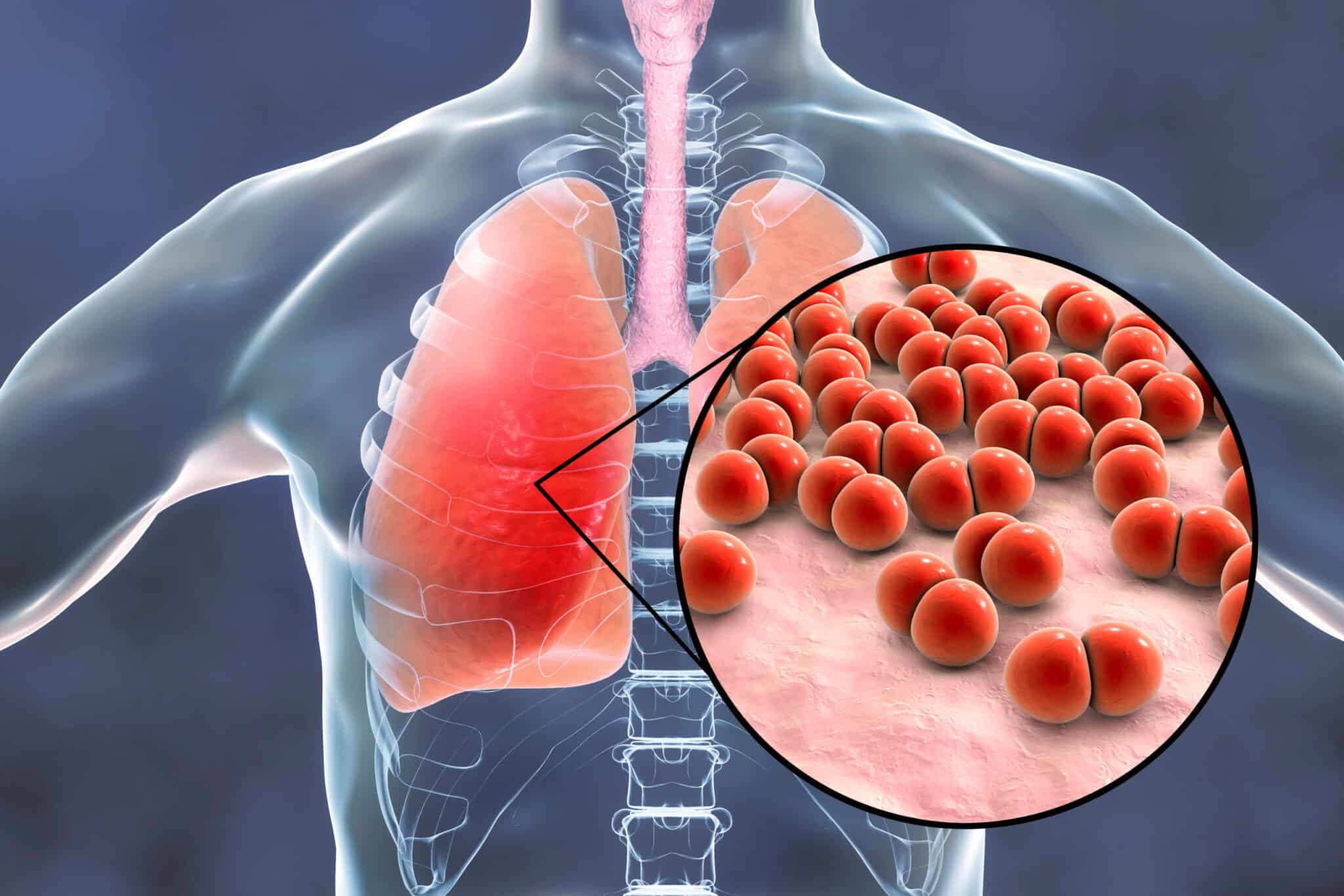 Pneumopathie infectieuse