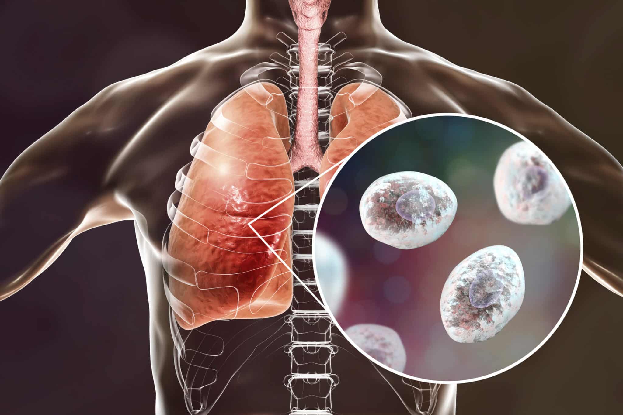 Pneumocystose