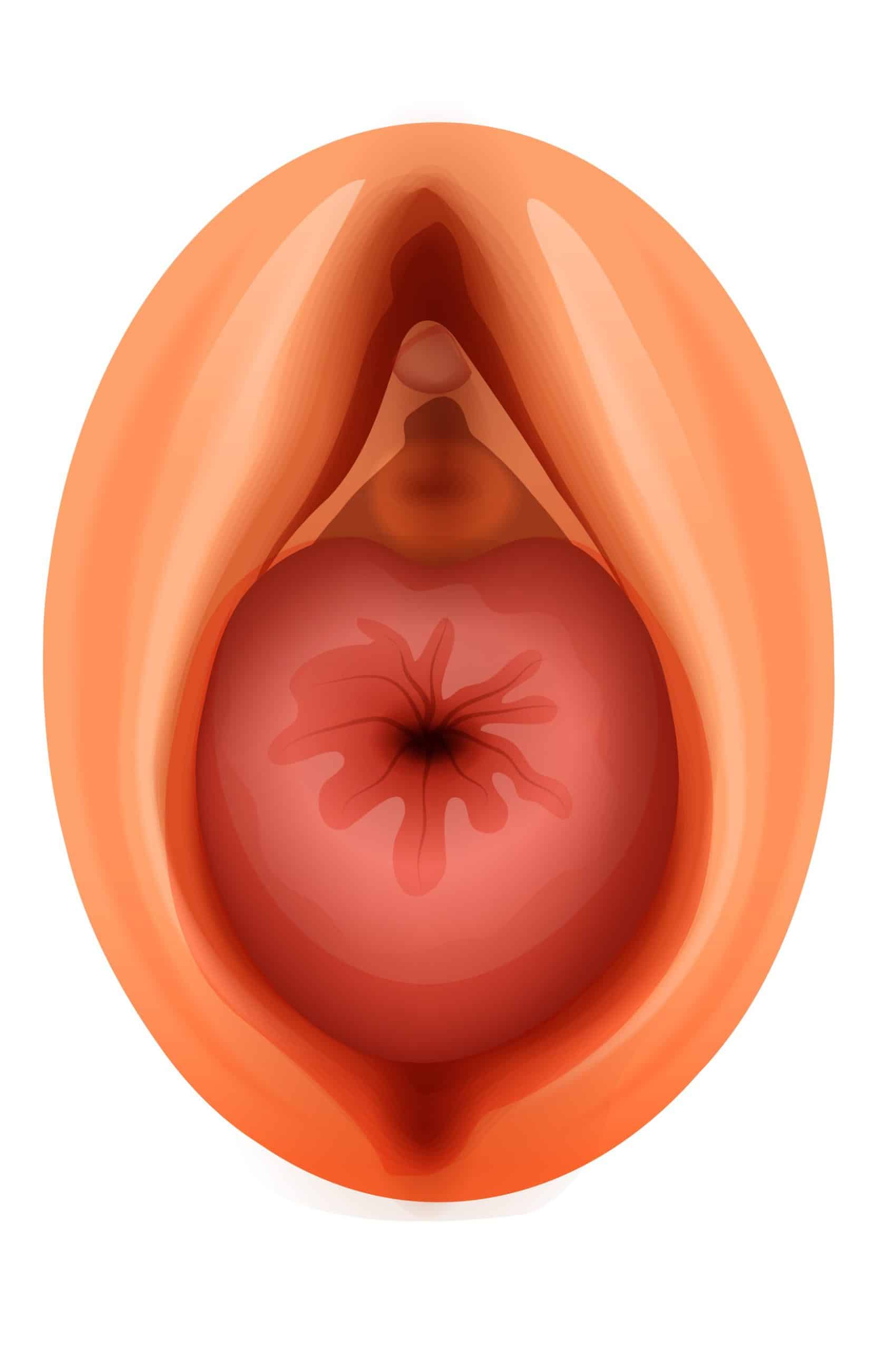 Descente d’organe chez la femme