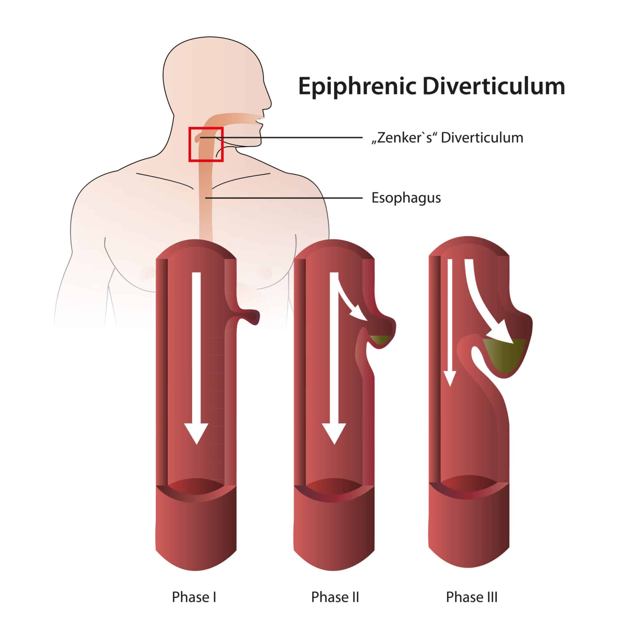 Diverticule de Zenker