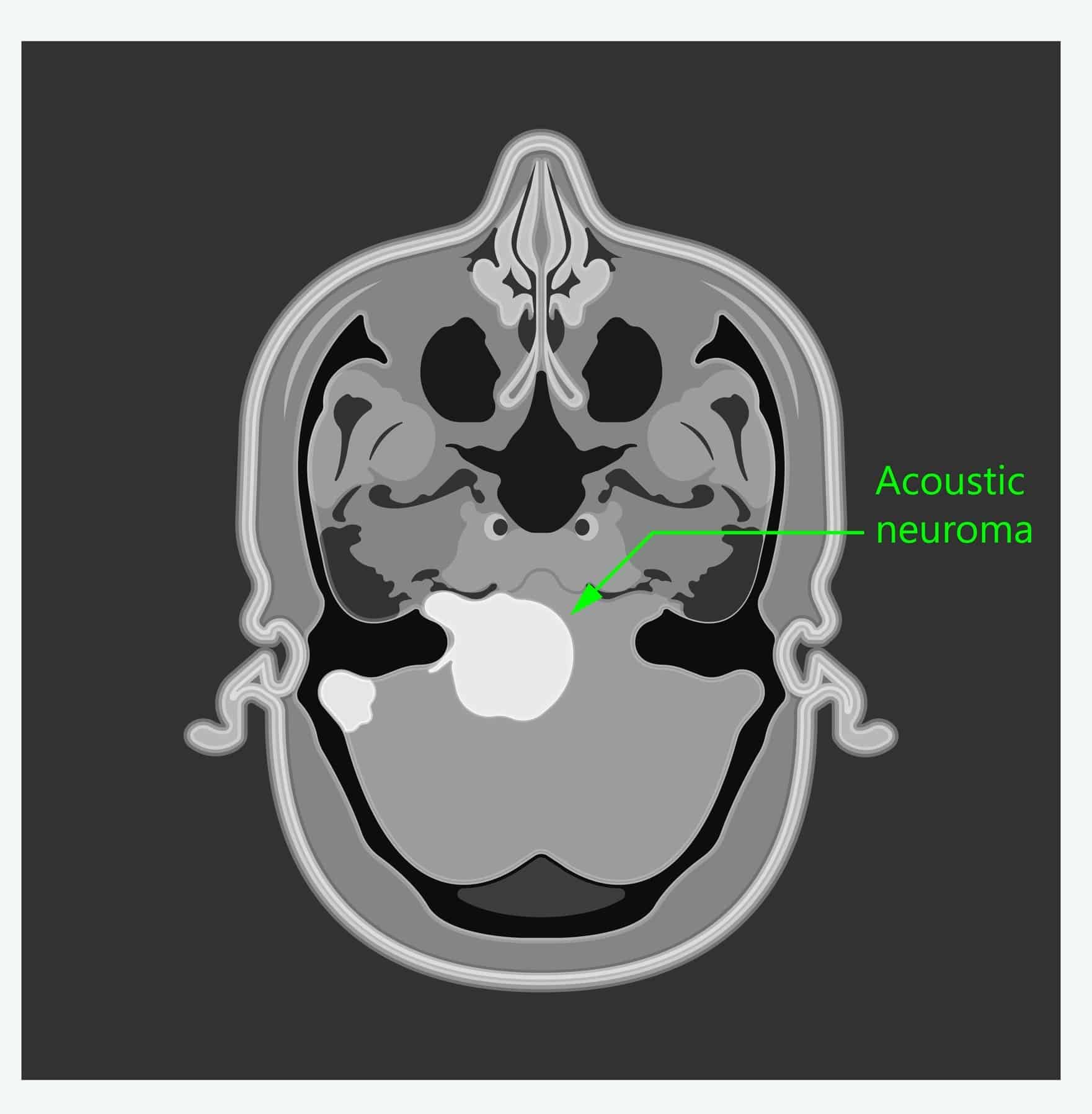 Neurinome du nerf de l’équilibre