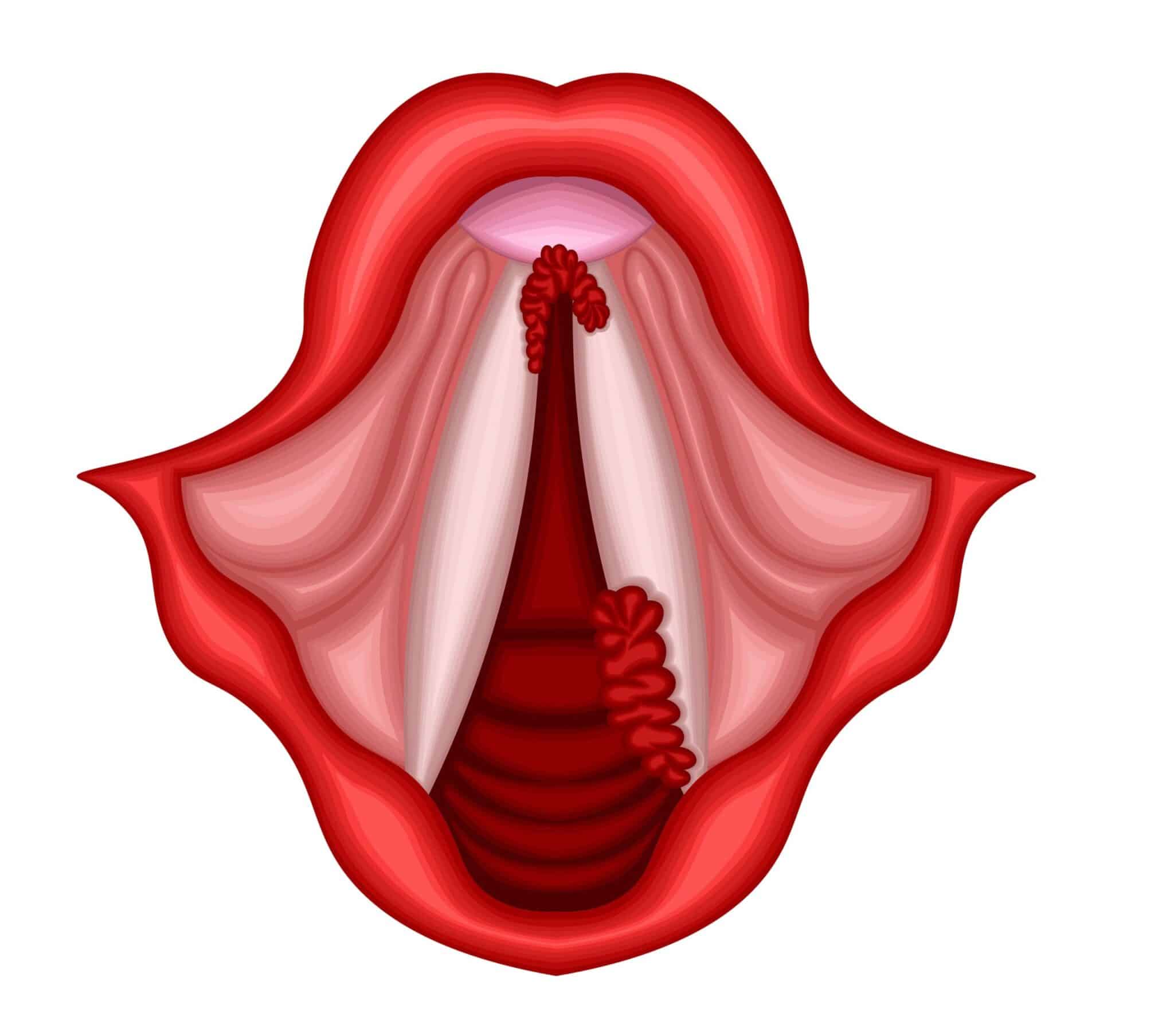 Granulome des cordes vocales