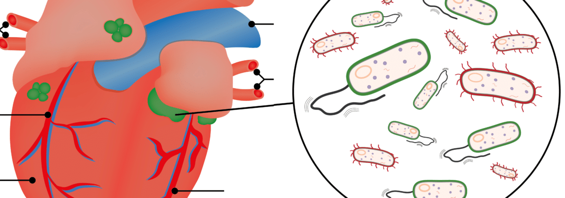 Endocardite infectieuse