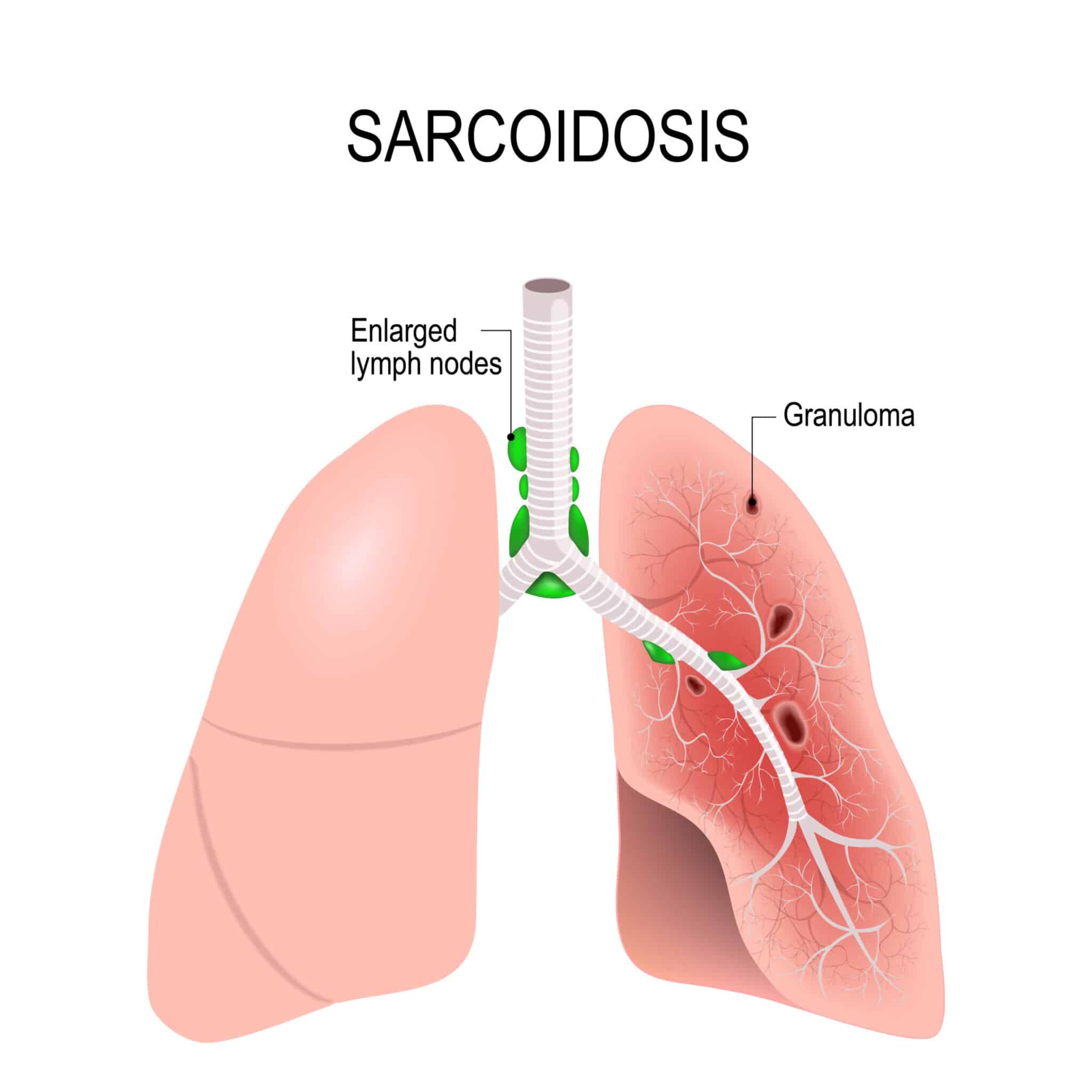 Sarcoïdose