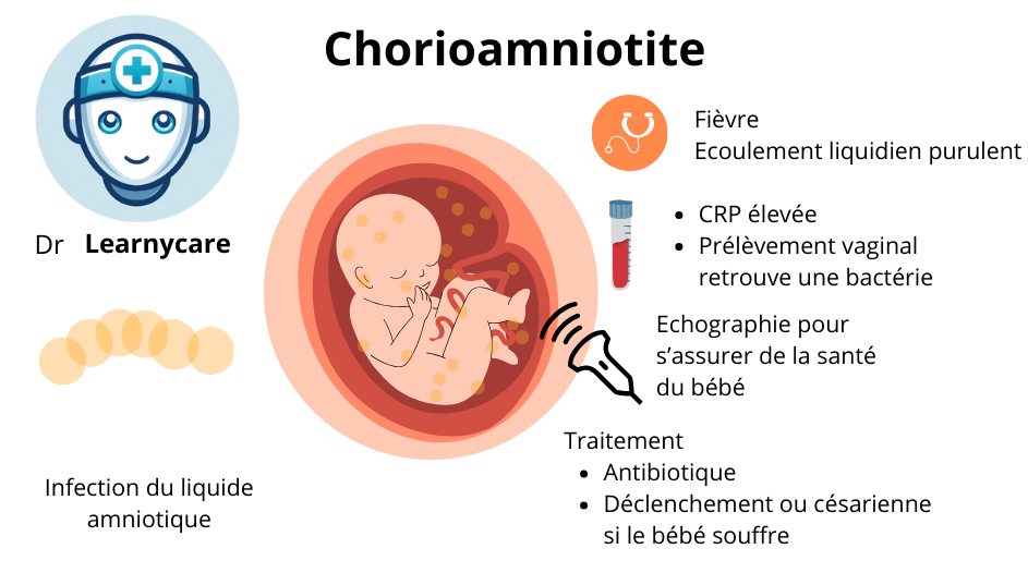 Chorioamniotique infographie