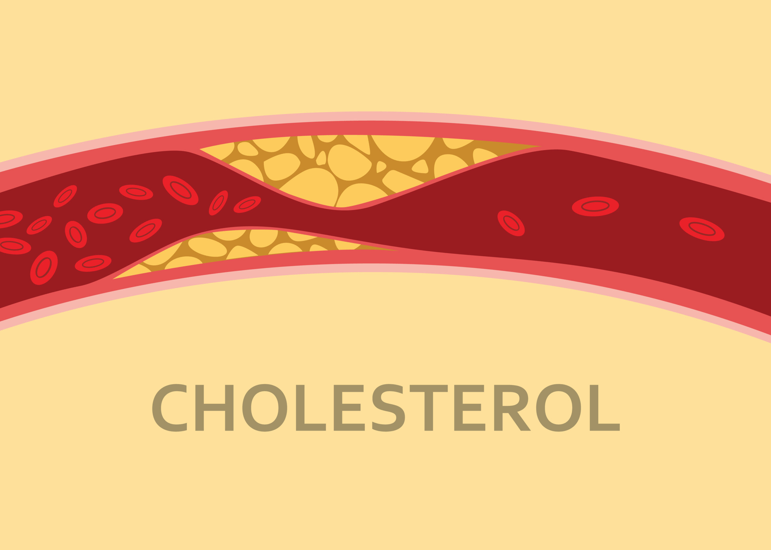 Embolies de cholestérol