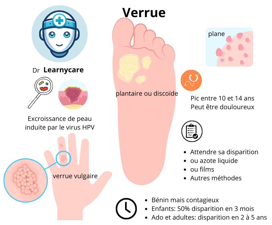 Verrue infographie